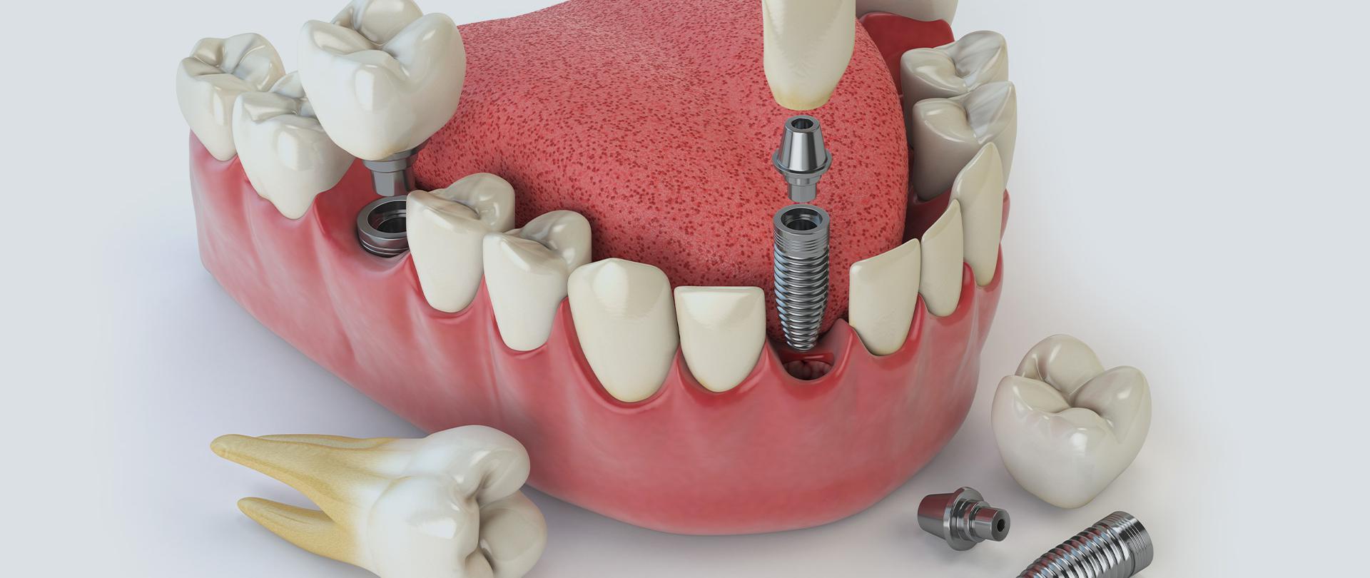 Dental Implant Treatment