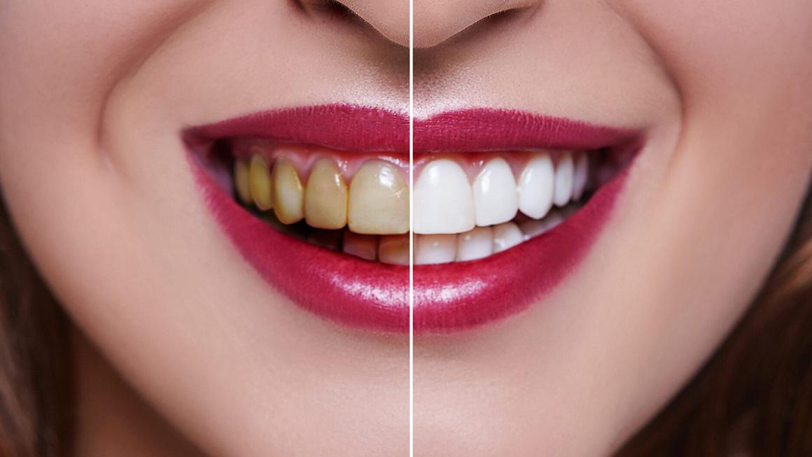 Tooth Bleaching