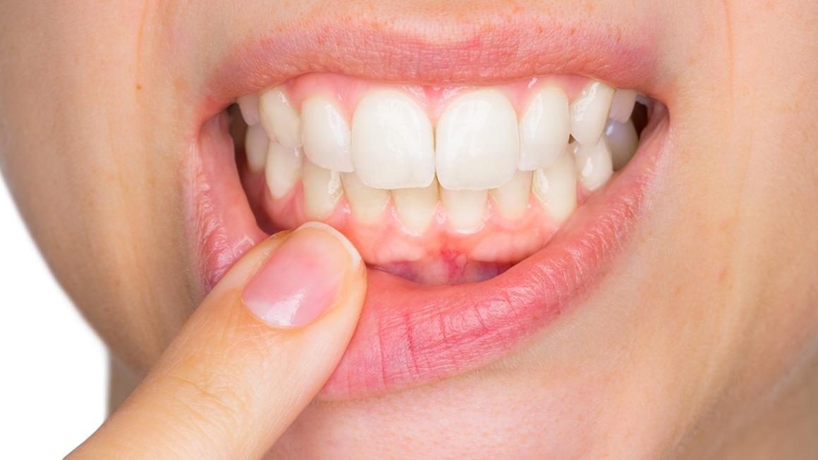 Zahnfleischkrankheiten Diagnose und Behandlungen