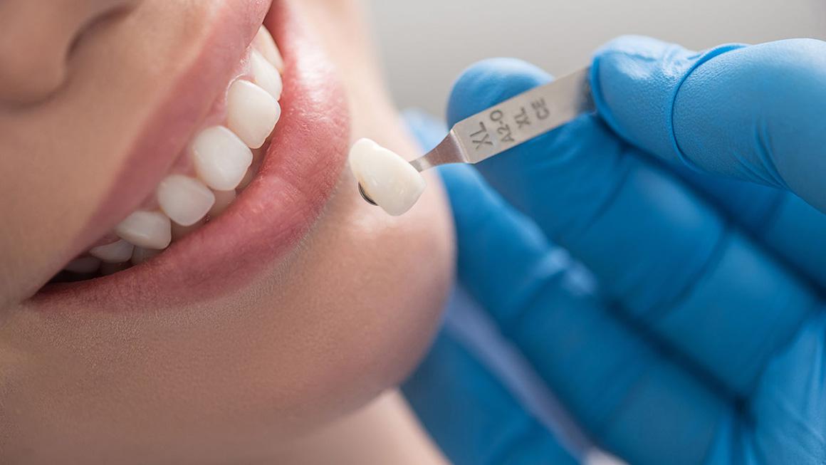Dental Crowns