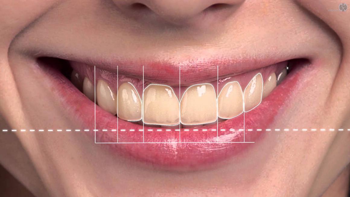 Smile Design