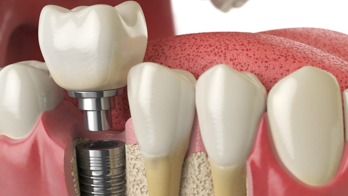 Dental Implant Treatment Dentasey Private Oral and Dental Health