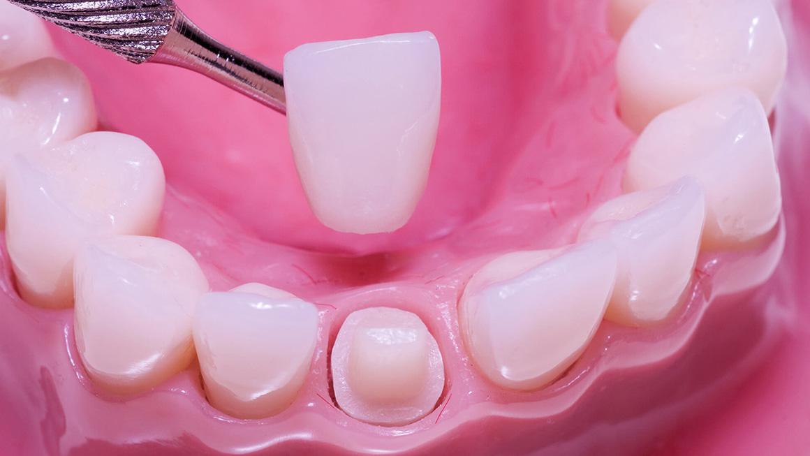 Zirconium Crowns